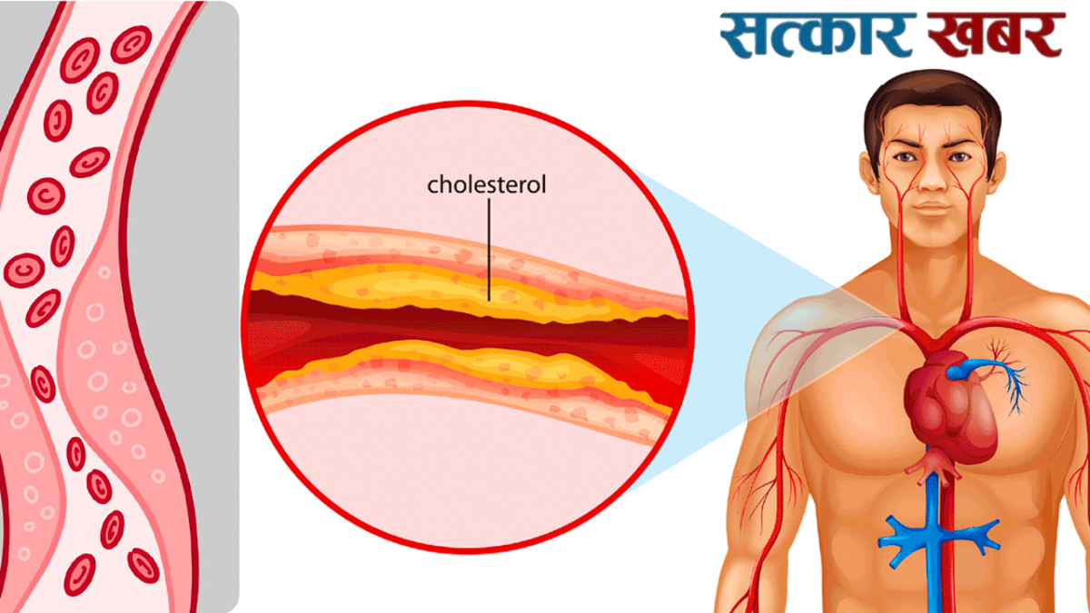 नसामा जमेको कोलेस्ट्रोल हटाउन मद्दत गर्ने ५ शक्तिशाली तरकारीहरू